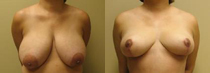 Breast - Reduction