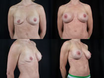 Breast - Revision